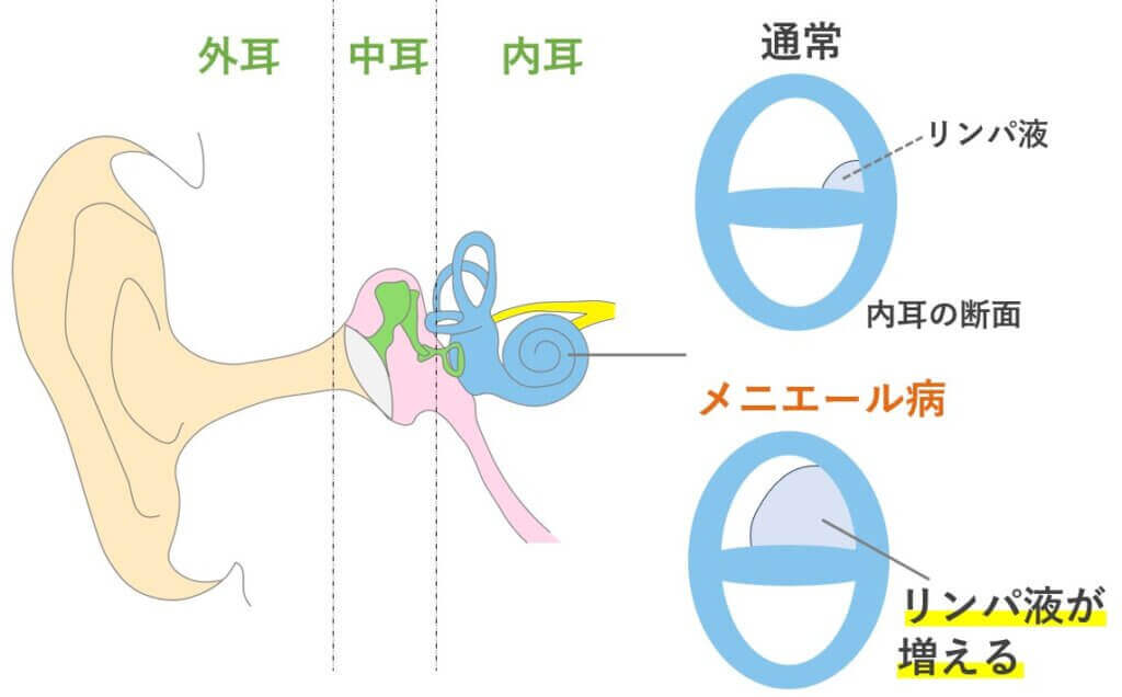 メニエール病でめまいや耳鳴りが出る原因はリンパ液？