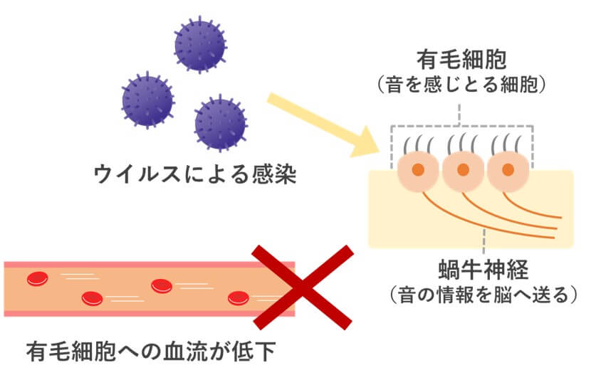 音を感じ取る有毛細胞の
ウイルス感染
血管の問題（血流の低下）
により発症するといわれています。