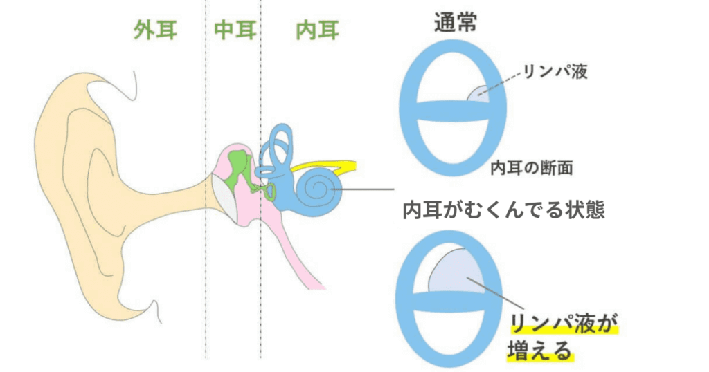低音障害型感音難聴の揺れやすい内耳環境をイメージ