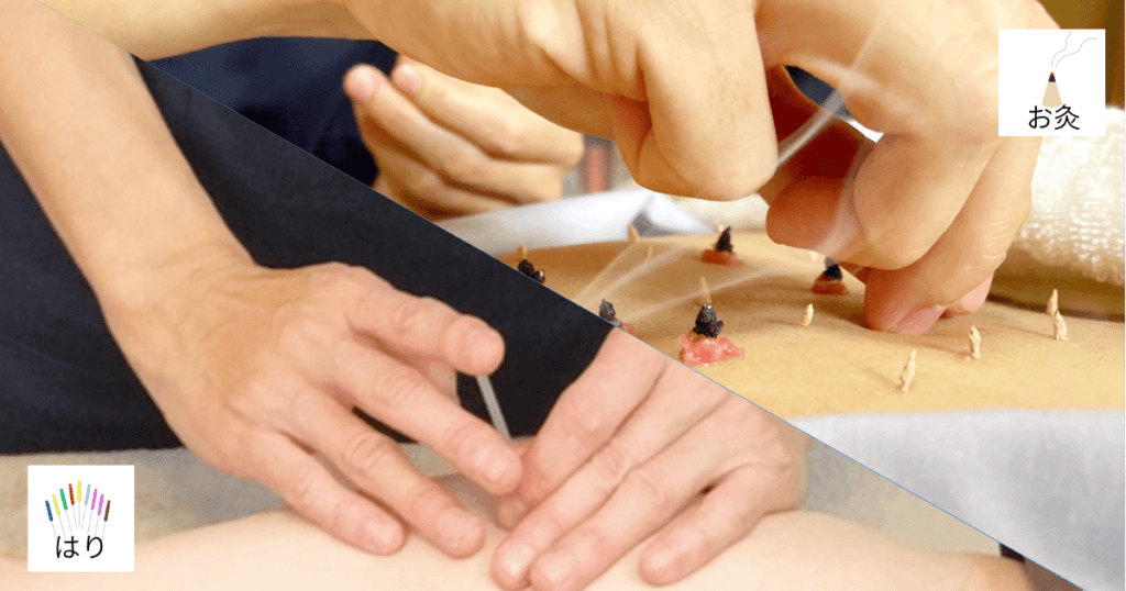 お灸とはりの写真